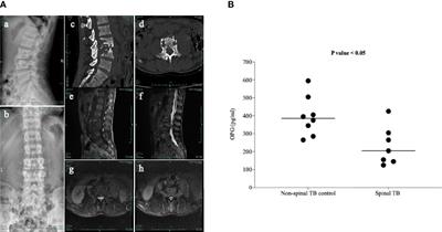 Mycobacterium tuberculosis Induced Osteoblast Dysregulation Involved in Bone Destruction in Spinal Tuberculosis